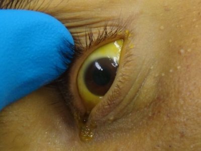 Jaundice – More than just Colour