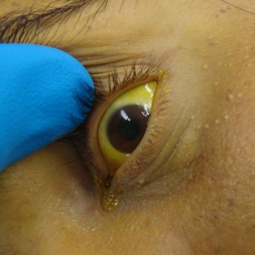 Jaundice – More than just Colour